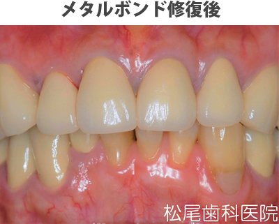メタルボンド