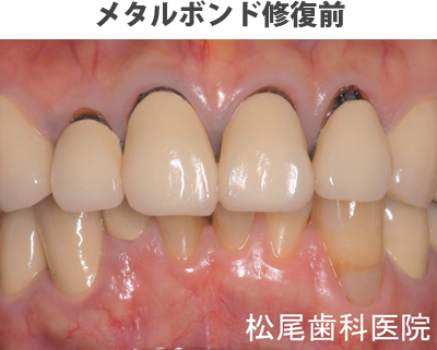 メタルボンド