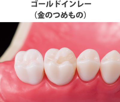 ゴールドインレー