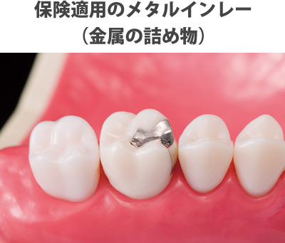ゴールドインレー